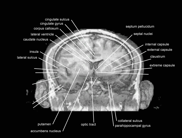 parahippocampal gyrus mri