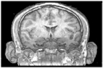 Coronal Plane