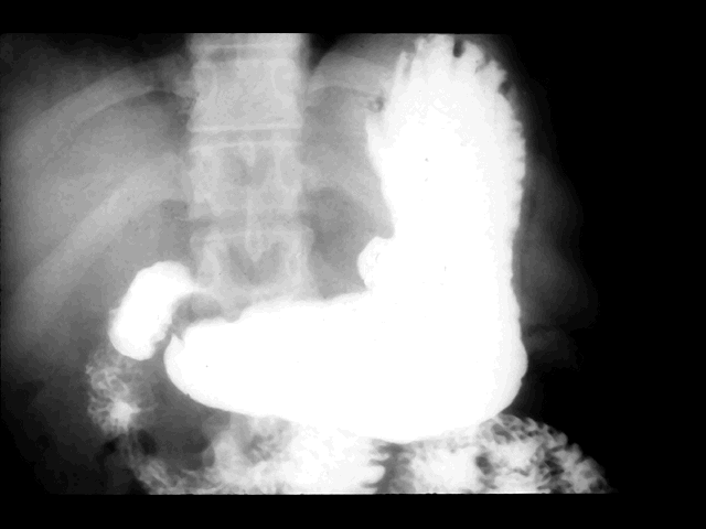 duodenal ulcer x ray