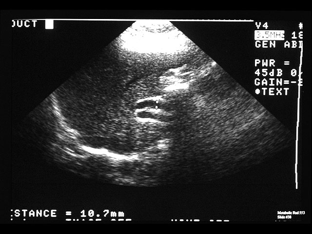 common bile duct stone. A dilated common bile duct