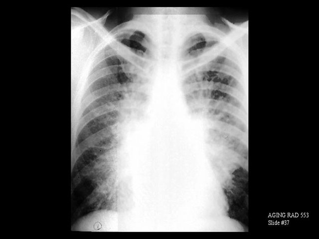 X-RAY: PA chest x-ray. Congestive heart failure with interstitial and 